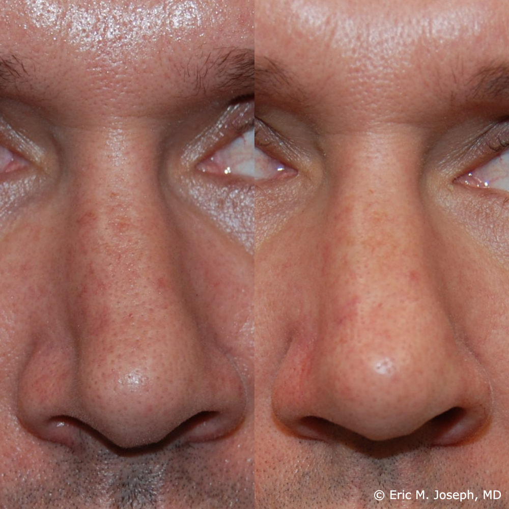 Non-Surgical Rhinoplasty — Eric M. Joseph, MD | Permanent Non